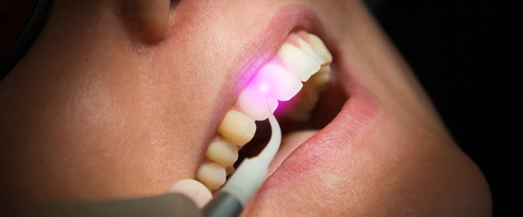 киста зуба лечение фото